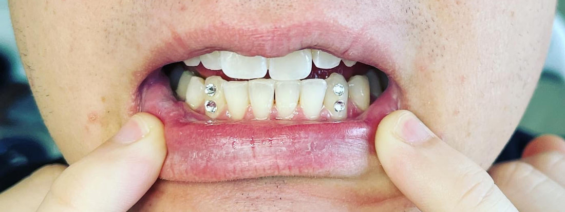A man pulls down his lip to show tooth gems on his lower incisors